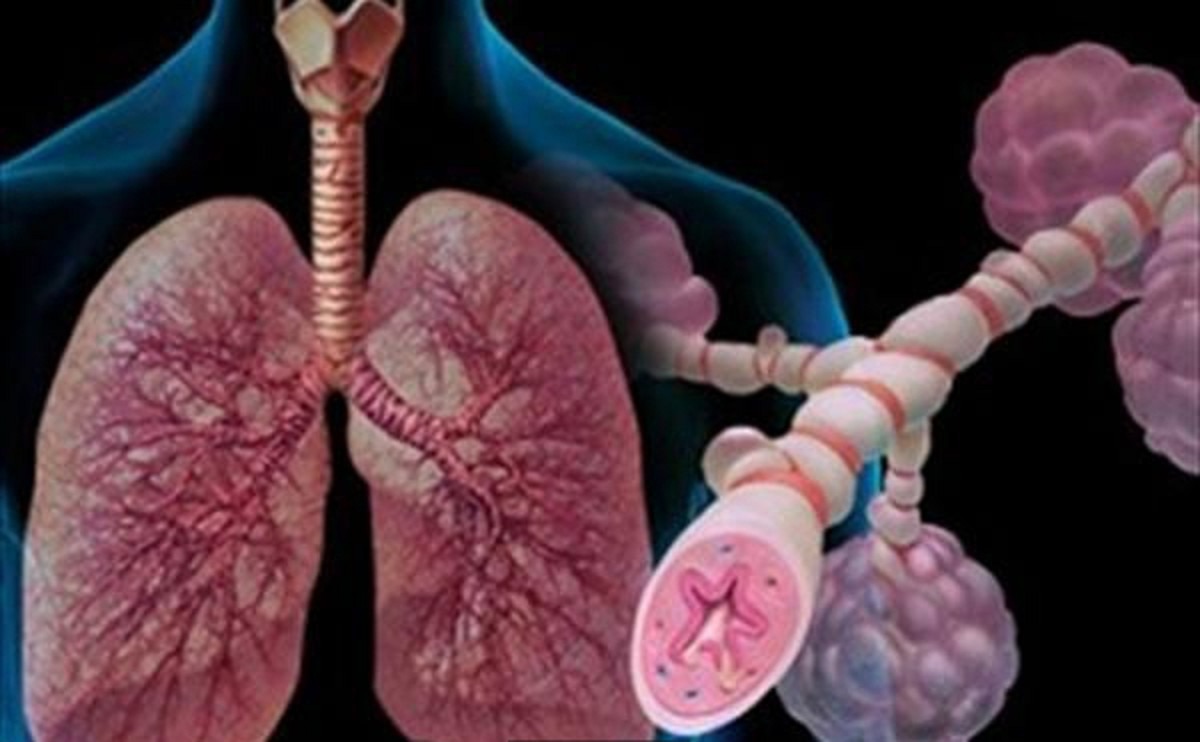 برونشیت یا حساسیت؟ راهنمای درمان سرفه‌های آزاردهنده فصلی